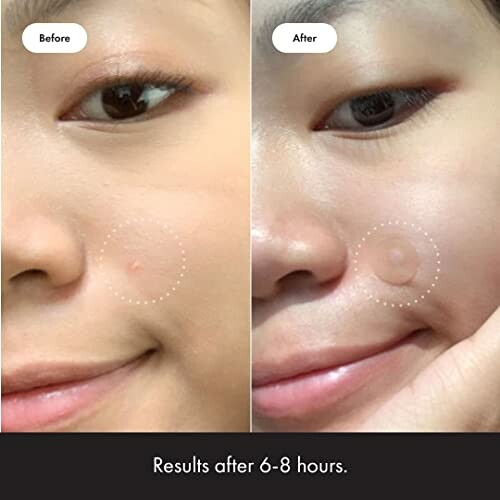 Comparison of skin with acne before and after treatment, showing improvement over 6-8 hours.