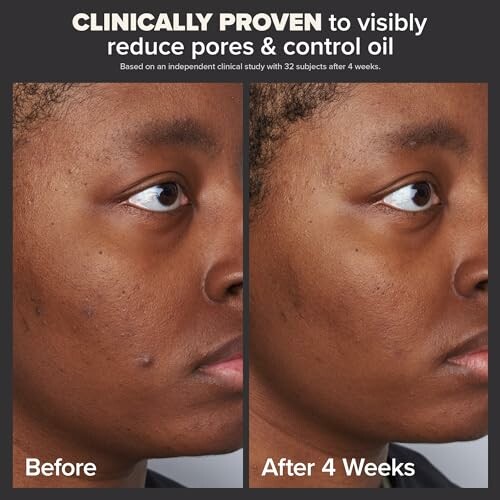 Comparison of skin before and after 4 weeks of treatment, showing reduced pores and oil control.